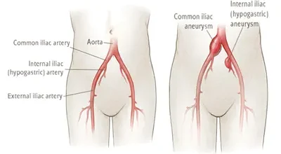 common-iliac